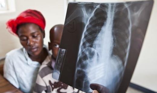 Kāds tuberkulozes simptoms bērniem tiek uzskatīts par slimības sākumu?