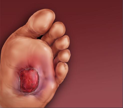 Diabēta pēdas: simptomi un klasifikācija
